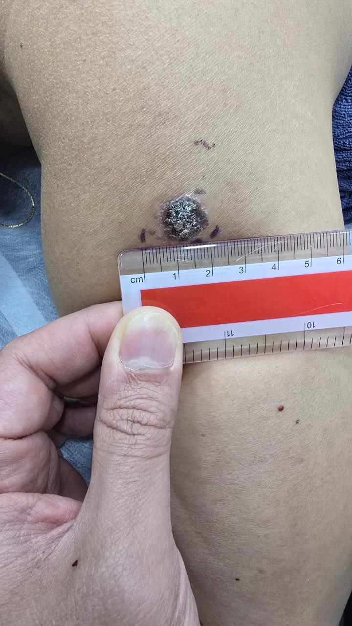 Bowen disease lesion initial assessment